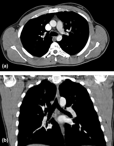 Figure 2a and b. Axial and coronal cuts of CT-scans showing resolution of mediastinal lymphadenopathy