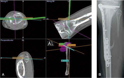 Figure 5. A. An image-based resection and reconstruction procedure; intraoperative screen shot of the navigation system. The pointer tool is being used to align 1 of the 2 resection planes of the proximal “dome”-type resection. An intraoperative view is shown in Figure 2. B. Anteroposterior radiograph of the patient 11 months after surgery. Progressive incorporation of the allograft and vascularized autograft.