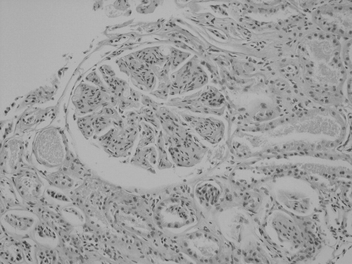 Figure 2.  Membranoproliferative morphology characterized by prominent mesangial and endocapillary proliferation accompanied by peripheral capillary loop thickening in the glomerulus (H&E-40).