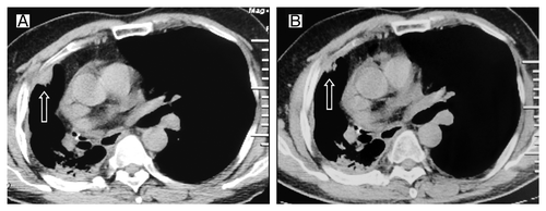 Figure 4. Tumor volume changes seen on CT (A) before the second erlotinib treatment; (B) 3 mo after the second erlotinib treatment.