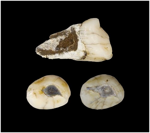 Figure 7. E-JUV individual #4. U.W. 101–1571 (top) and occlusal of U.W. 101–1571 (left) and U.W. 101–824 (right).
