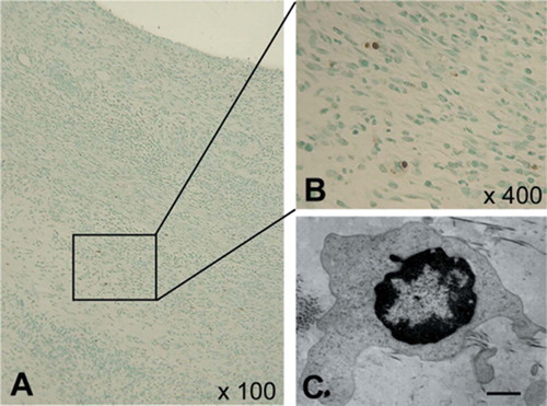 Figure 10. Confirmation of apoptotic cells. A and B: TUNEL staining sections showing the localization of apoptotic cells; 100× and 400× magnification, respectively. The rectangle indicates the area of panel B. C: Electron microscopy showing findings compatible with apoptosis (bar represents 1.0 μm).