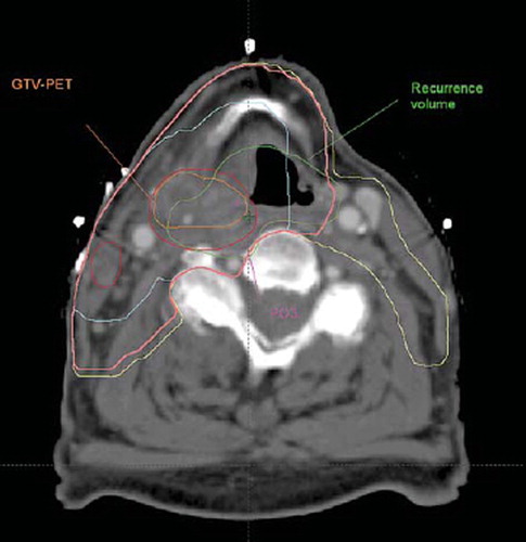 Figure 1. Treatment planning scan (CTtherapy) with the contours of the target volumes and the transferred recurrence volume and a point of origin. for this patient, all four POs and the COV were located in the GTV-PET. The recurrence volume is certainly overlapping the GTV-PET, and all the foci of the expert and COV are located therein, but the volumetric approach with a 95% threshold point to the CTVE-l as the likely target volume where the recurrence occurs. With a 50% threshold, the volumetric approach ascribes the site of recurrence to the GTV. Magenta: Point of Origin identified on therapy scan. Orange: GTV-PET. Red: GTV. Turquoise: GTV-oncologist. Pink: CTVE-h. Yellow: CTVE-l. Green: Recurrence volume