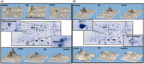 Figure 3. Differenially-expressed proteins in PMN from SM-exposed and COPD patients. Protein spots expressed differently in the PMN of the same SM-exposed and COPD patients shown in Figure 1. (A) ER-proteses 60 (Spot 19) and S100A9 (spot 1). (B) GSTp (Spot 12) and GST omega1 (Spot 13). The 3-D images of differential spots between the patients were analyzed using ImageMaster 2D Platinum software.