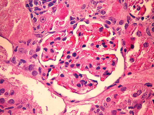 Figure 3. Histopathological view of renal sections in GCa-group (HE ×400).
