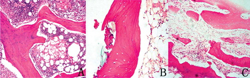 Figure 5. Histological findings in the femoral head following injection of methylprednisolone and lipopolysaccharide in rabbits. Mid-coronal section from rabbit femoral head 6 weeks after the injection, stained with hematoxylin-eosin. A. Marrow necrosis (x100). B. Trabecular necrosis (x200). C. Trabecular necrosis and dense medullary fibrosis (x100).