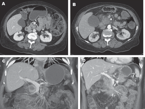 Figure 2. Contrast-enhanced CT of the abdomen showing evidence of a hypodense mass in the uncinate process. Patient A has a clearly defined fat plane between the mass and the superior mesenteric vein (SMV). The fat plane is absent in Patient B suggesting invasion of the vein. C and D show coronal views of a mass without and with SMV invasion, respectively.