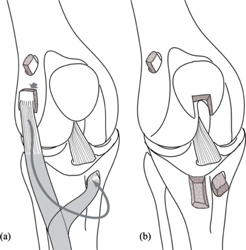 Figure 1. Both techniques of ACL reconstruction, using the pediculated tendon of the extensor digitorum longus (a), and using the free bone-tendon-bone autograft from the central third of the patellar ligament (b).
