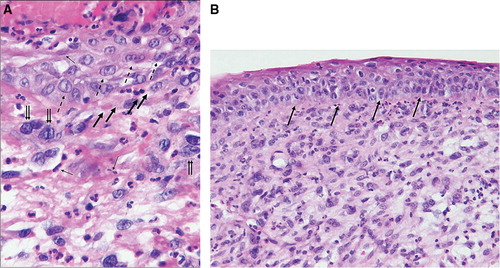 Figure 2. Hematoxylin-eosin stain section of the lesion. (a) Tumor giant cells are marked with double arrows. Pseudovascular spaces demonstrated with bold arrows. Spindle neoplastic cells exemplified with simple arrows, and purely differentiated squamous epithelial cell carcinoma at the surface are marked with dashed arrows (× 400). (b) Squamous cell carcinoma in situ component as marked with arrows separated from the underlying sarcomatoid tumor tissue (× 200).