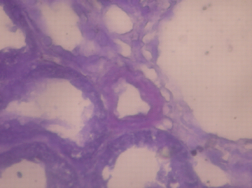 Figure 2. Crystal violet X400 deposition of amyloid on renal biopsy. (View this art in color atwww.dekker.com.)