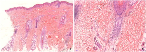 Figure 2. Histopathologic features (hematoxylin-eosin staining). (a) The numbere of follicles decreased significantly with high proportions of follicles in catagen or telogen (original magnification ×50). (b) Vertical columns of connective tissue can be seen (original magnification ×200).