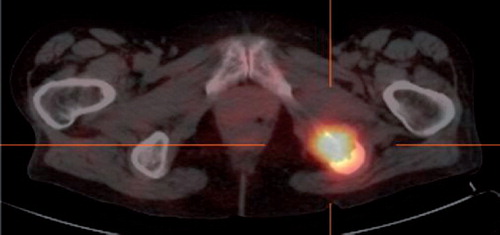 Figure 1. A 111In-octreotide SPECT/CT in Case 3 patient, as baseline before sunitinib treatment. The patient have a focus of markedly increased receptor density in the left tuber ischiadicum, showing relaps of disease after eight years remission.
