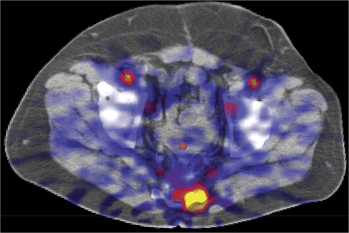 Figure 4. CT image with fused perfusion-weighted PET image shows the ROI used for the position of the catheter in the bladder.