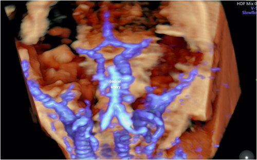 Figure 3. Fetal basilar artery analysis via three-dimensional SlowFlow HD in the second trimester.