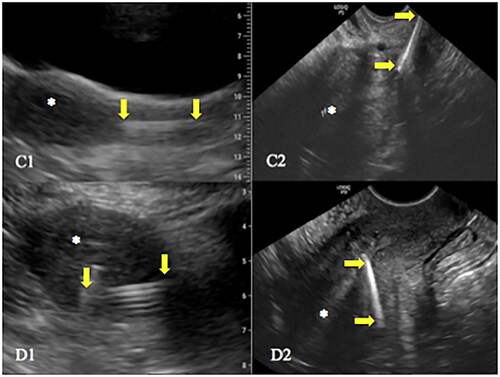 Figure 4. Ultrasonographic images. C - copper IUD entirely within the cervical canal by both POCUS (C1) and conventional US (C2); D - copper IUD embedded in the myometrium by both POCUS (D1) and conventional US (D2). The top and the distal end of the IUDs are indicated by yellow arrows. Asterisks indicate the fundal region of the endometrial cavity.