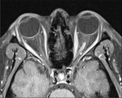 Figure 2 A postcontrast axial T1-weighted fat-suppressed MRI of the orbits in a NMO patient showed enhanced left optic nerve. The finding was consistent with acute left optic neuritis.