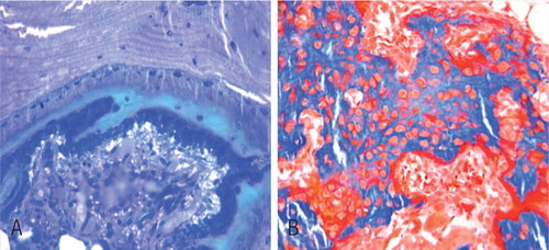 Figure 4. 2 different patterns of new bone formation. A. One occurred on the surface of pre-existing trabeculae to form the lamellar bone directly (Giemsa stain, 200× magnification). B. The other occurred at the inter-trabecular marrow, like a “map” with a high number of cells inside the new-formed woven bone (Goldner stain, 200× magnification).