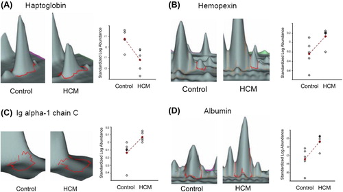 Figure 3. Three-dimensional view of differentially expressed proteins in serum samples from HCM patients compared with controls. Changes in protein expression from HCM and controls are shown by each line. The average ratio of expression for each selected protein grouping in HCM and control specimens as obtained by computational analysis with DeCyder Software is represented by lines marked with a cross. Statistical analysis allowed detection of significant abundance changes (95th confidence level) based on the variance of the mean change within the cohort: A: haptoglobin; B: hemopexin; C: Ig alpha-1 chain C region isoform; D: albumin.