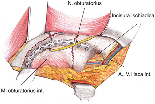 Figure 2. The medial wall and dorsal column of the right acetabulum are exposed. A fracture of the medial wall is stabilized with a bridging plate.