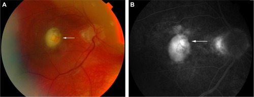 Figure 9 Color retinal (A) and FFA (B) photographs of a VKHD patient with macular CNV (white arrows).
