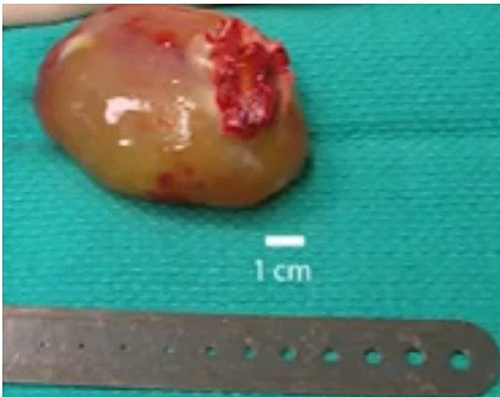 Figure 1 Sample from the excisional biopsy showing low-grade myxoma.