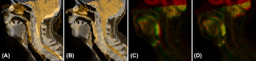 Figure 1. Fusion images after RR and DR for Patient 4. Fusion of the original CT (gray) and the deformed MR (orange) after RR (A) and after DR with LMI+ BEP (B). Fusion of the PET of the PET/CT (red) and the deformed PET of the PET/MR (green) after RR (C) and after DR with LMI+ BEP (D).