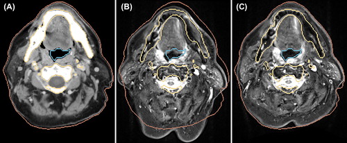 Figure 3. Axial slices of the original CT (A), transformed MR from RR (B) and from DR with LMI+ BEP (C) for Patient 2. Contours of skin (brown), bones (yellow) and respiratory tract (blue) derived from the original CT are also shown.