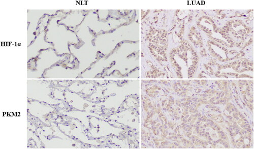 Figure 2. Different expressions of HIF-1α and PKM2 in normal lung tissue (NLT) and lung adenocarcinoma (LUAD).