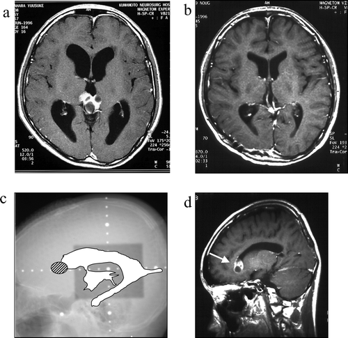 Figure 2.  Case 2, a 15-year-old boy. a: Pre-treatment MRI scan revealing a pineal mass. b: Post-treatment MRI scan reveals complete disappearance of the pineal mass. c: On this x-radiograph, the field of irradiation (gray area) and the ventricles (white area) on MRI scans are traced. The relapse site is identified by a hatched circle. d: This post-treatment MRI scan reveals an enhanced lesion in the anterior horn of the right lateral ventricle (arrow).