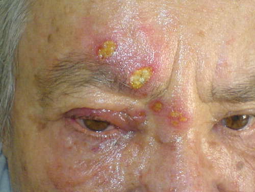 Figure 1. Erythematous swelling, vesicles, and superficial ulceration around the right eye.