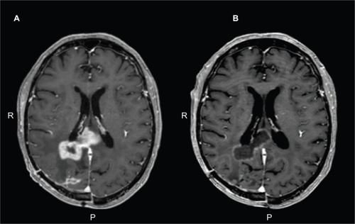 Figure 1 A) Axial T1-weighted, post-contrast image of the brain in a patient with glioblastoma multiforme who progressed on temozolomide therapy. B) Response after 2 months of bevacizumab monotherapy.
