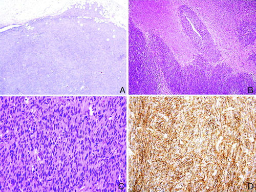 Figure 2. Histology of EGIST. A. Low power view shows that the tumor cells are composed of spindle cells and invade the surrounding tissue (hematoxylin and eosin×40). B. Extensive tumoral necrosis is noted (hematoxylin and eosin×100). C. High power view demonstrates frequent mitoses (60/10 High power field, hematoxylin and eosin×200). D. Immunohistochemically, the tumor cells test strongly positive for c-kit (×200).
