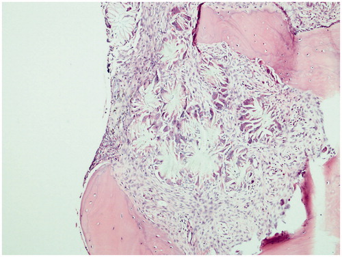 Figure 1. Foreign body granulomatous reaction filling almost all the intertrabecular area (H&E, ×100).