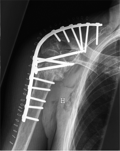 Figure 1. Shoulder arthrodesis with stable plate fixation.