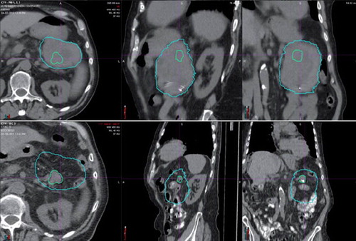 Figure 2. Patient #5 presented with a marginally resectable adenocarcinoma of the pancreatic tail (top three images). He achieved a virtual complete radiographic response (bottom three images) after 50.40 CGE in 28 fractions with oral concomitant capecitabine at 1000 mg twice daily on treatment days. He did not undergo surgery due to the emergence of multiple liver metastases shortly after completion of proton therapy.