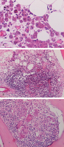 Figure 5.  Femoral bone marrow from a revised MoM hip resurfacing showing (a) a collection of macrophages containing metal particles (arrowed); (b) a small lymphoid aggregate; and (c) a discrete macrophage and giant cell granuloma.