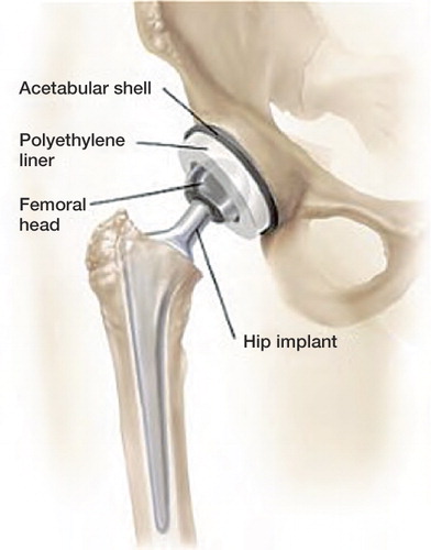 Figure 1. Total hip arthroplasty