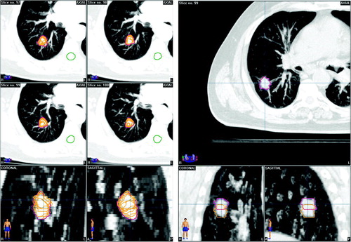 Figure 3.  Examples of MIP scans that incorporate tumor mobility from all phases of the 4DCT scan. Left panel: Projection of GTVs from 10 phase bins (yellow) onto a maximum intensity projection (MIP) CT scan, with contouring on the MIP scan shown in red. Right panel: The end-inspiratory (yellow) and end-expiratory (pink) GTVs from the 4DCT of another patient, projected onto the MIP scan.