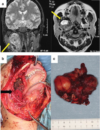 Figure 1. (a) Preoperative magnetic resonance T2 images of patient 1. (b, c) Illustrations showing patient 1 just after tumor resection. (b) The mandible osteotomy approach was selected. The resection resulted in a large oropharyngeal defect, and the internal carotid artery was exposed (black arrow). (c) Illustration showing the grossly resected tumor.