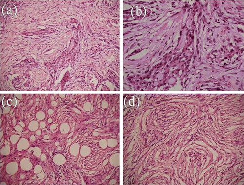 Figure 2.  Photomicrograph of patient 3 showing islands of glial tissue alternating with fibroblastic stroma (a, H&E×100; b H&E×200). Another area showing fibroblastic tissue with adipose like areas (c, H&E×100) and at places showing whorling (d, H&E×100).
