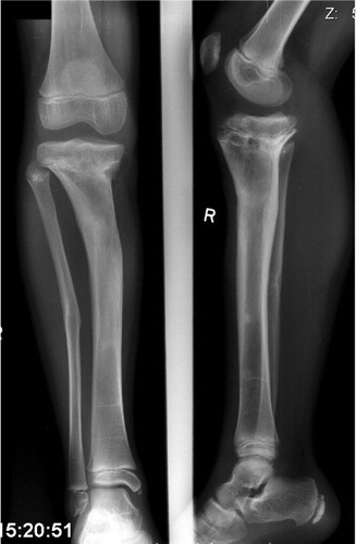 Figure 4. Frontal plane double deformity of the tibia with LLD of 5.5 cm in a patient with a history of osteomyelitis in early childhood and of previous operations.