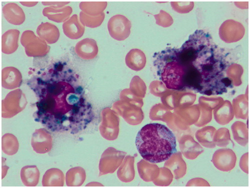 Figure 5. A representative marrow smear (performed after two IB DLI) with a focus on macrophages phagocytizing cellular remnants.