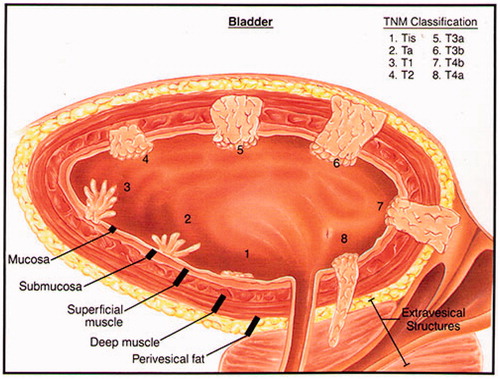 Figure 1. Pictorial cross-section of bladder cancer staging classification as regards penetration of disease into the bladder wall. Reprinted with permission from Katelaris Urology, http://www.katelarisurology.com.au/about-bladder-cancer/.