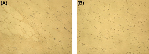 Figure 5. Immunohistochemical staining of IIINTP in myocardium of idiopathic fibrosis case (A) and in control case (B). Magnification × 200. The amount of IIINTP did not differ between the IMF case and control myocardium.