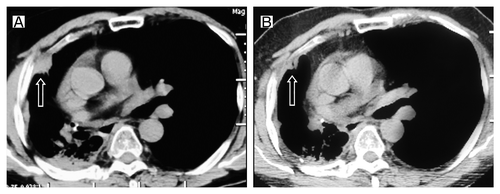 Figure 2. Tumor volume changes seen on CT (A) before the first erlotinib treatment; (B) 2 mo after the first erlotinib treatment.