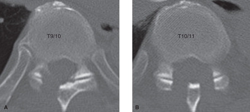 Figure 4. CT images of the thoracic spine after the operation. Sufficient decompression was accomplished at the right T9–10 (A) and bilateral T10–11 (B) levels.