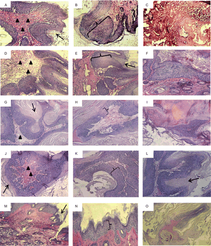 Figure 3.  Histological analysis of skin tumors induced by 7,12-dimethylbenz(a)anthracene (DMBA)/12-O-tetradecanoyl phorobol-13-acetate (TPA) treatment in mice removed after 20 weeks. Periodic acid Schiff (PAS) staining revealed the differences concerning several morphological features between the control (A–C), gavage treated groups (D–F), intraperitoneal treated groups (G–I), 5% treated groups (J–L), and the 50% topical treated groups (M–O). Black brackets points to the intensity of hyperplasia, black arrows point to hyperkeratosis, and black arrow heads indicate the levels of infiltration and the density of collagen core bundles. 200× magnification.