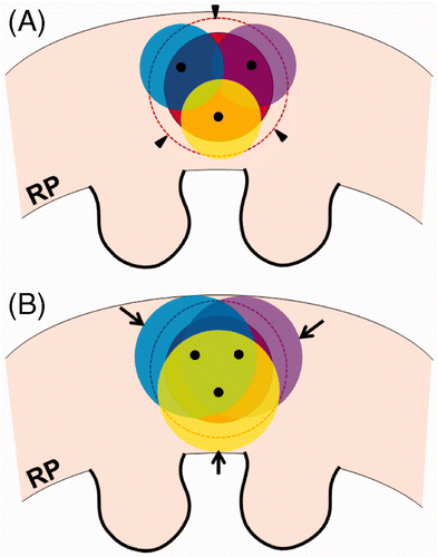 Figure 4. Over-ablation beyond the tumour margin during the cryoablation procedure. (A) For cryoablation of a spherical RCC (red), the ends (black dots) of three cryoprobes are seen within the tumour. The ice balls (yellow, blue, and violet) do not cover the entire tumour margin (arrowheads). (B) The ice balls grow to completely cover the tumour margin. However, some over-ablation of normal renal tissue (arrows) is noted beyond the tumour margin.