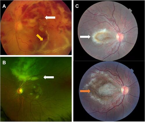 Figure 2 Examples of fundus findings from our cases of pediatric CMV retinitis. (A) Color photo of left eye with hemorrhagic retinal necrosis (white arrow) and perivascular sheathing (yellow arrow) predominantly involving the macula in a 1-year old male with history of medulloblastoma and autologous hematopoietic progenitor cell transplantation. (B) Optos photo of left eye showing centripetal perivascular retinal whitening (white arrow) in a 15-year-old male with acute lymphocytic leukemia on maintenance chemotherapy of imatinib. (C) Color photos of right eye showing a central white granular lesion of the macula before (white arrow) and 2 months after (Orange arrow) systemic antiviral treatment in a patient with SCID. There was no peripheral involvement in either eye for this patient.