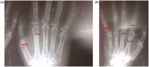 Figure 2. X ray of both hands showing calcification of (A) radial artery and (B) digital arteries.
